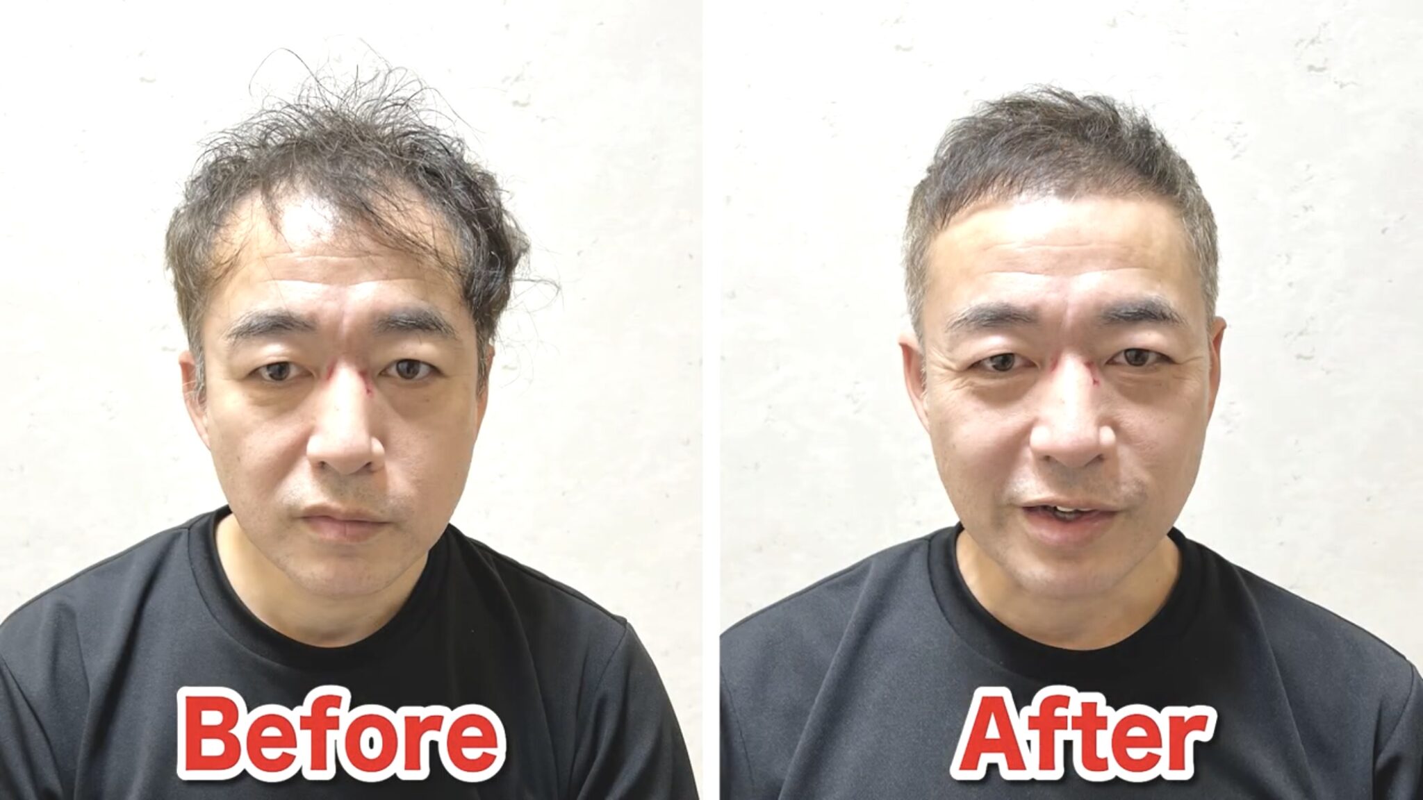 M字ハゲに似合う髪型5選｜カットの原則からセット手順まで薄毛専門美容師が解説 - AGA薄毛の悩みを解決する美容師ブログ｜M字・O字・U字の ...