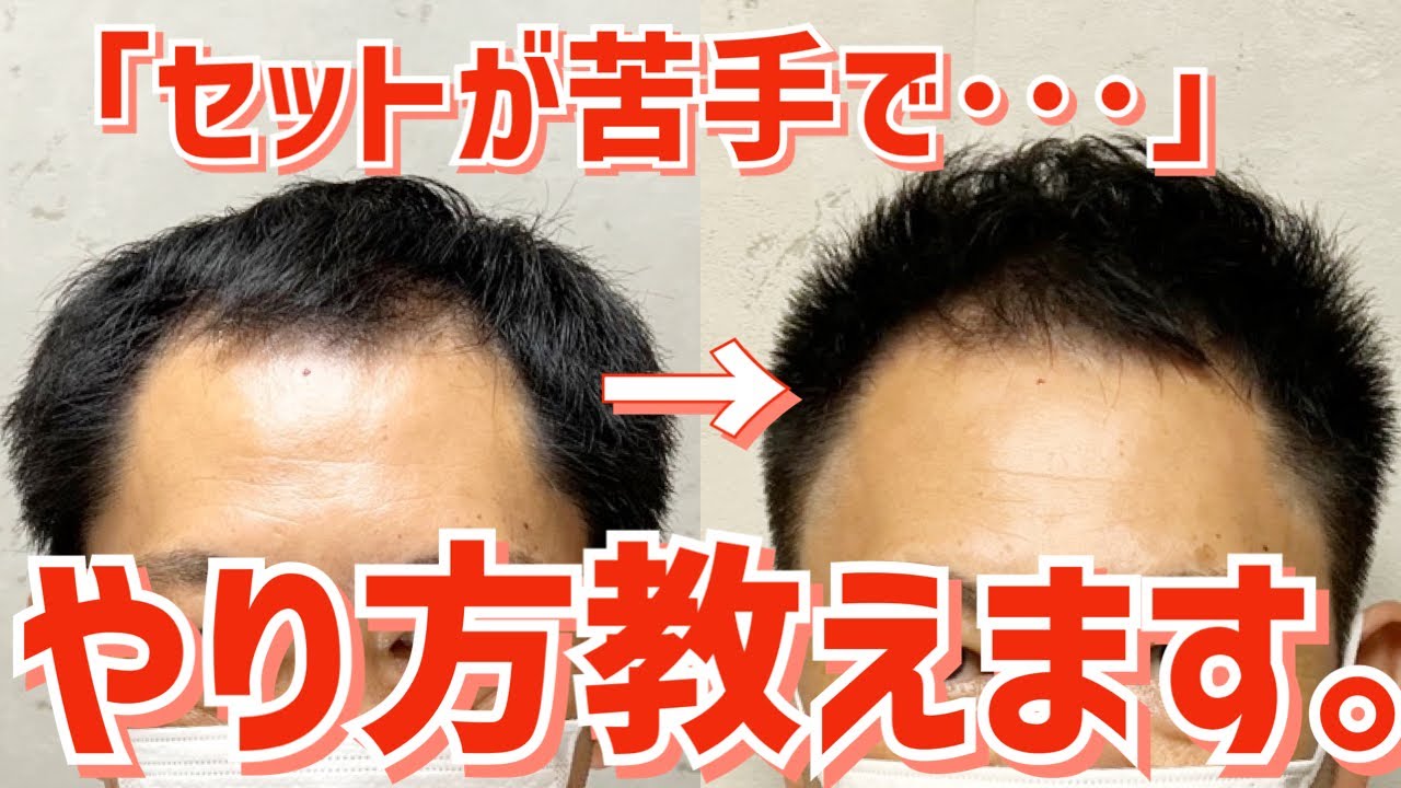 RELIVE 薄毛セット術 before/after【M字はげをショートヘアでカバー】