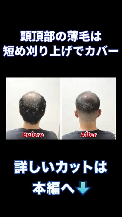 RELIVE 薄毛×坊主ビフォーアフター