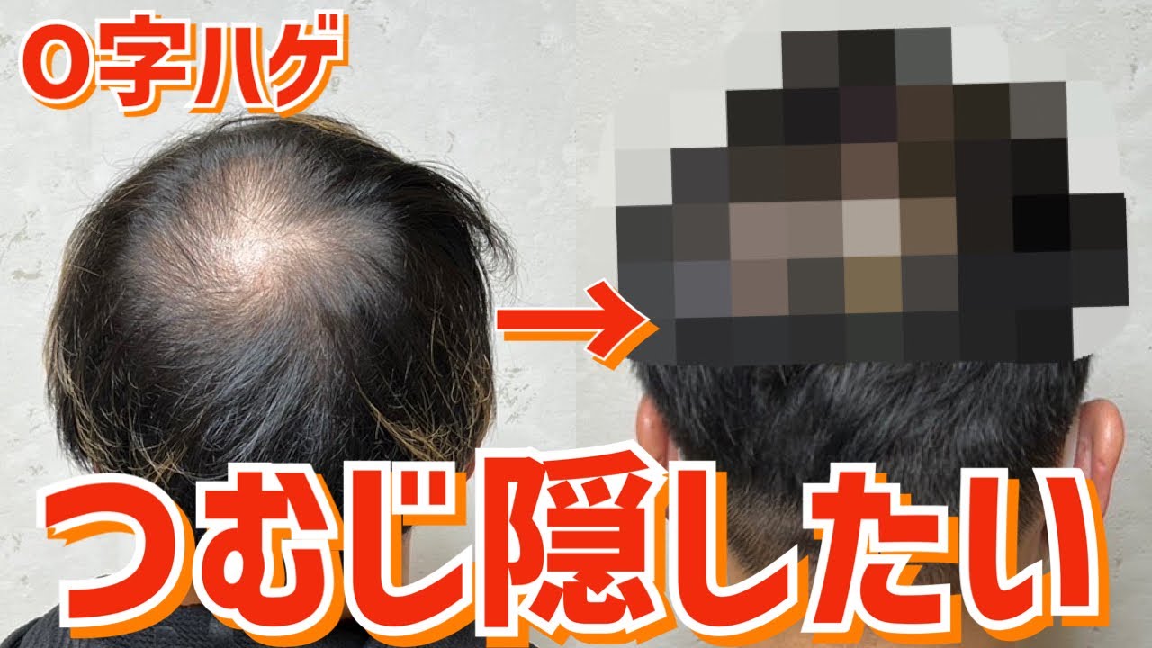RELIVE 頭頂部薄毛カバー解説